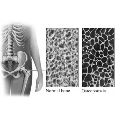 La cura naturale con magneti a campo stabile complementare alla terapia con farmaci nell'Osteoporosi  . 
