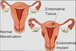 Endometriosi : sintomi,diagnosi e terapia naturale