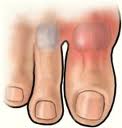 cura naturale gotta ed iperuricemia 