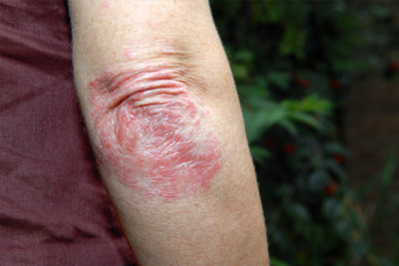 rimedi naturali per curare  la  Psoriasi  