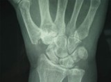 La magnetoterapia ad alta frequenza rizoartrosi o artrosi della mano . 
